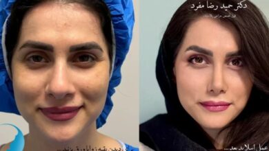 تحول طبیعی چهره با بینی نیمه فانتزی| تخصص دکتر حمید رضا مفرد یکی از گزینه های برتر است؟