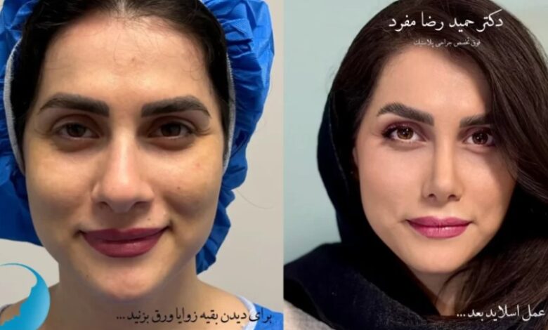 تحول طبیعی چهره با بینی نیمه فانتزی| تخصص دکتر حمید رضا مفرد یکی از گزینه های برتر است؟